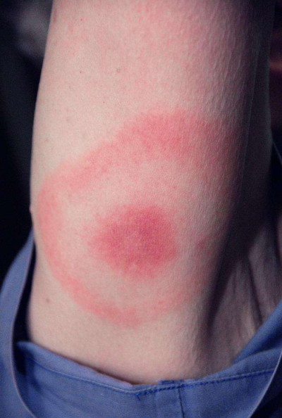 Bullseye Rash Linked to Lyme Disease