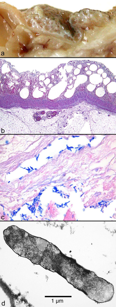 Pneumatosis coli Gas Gangrene