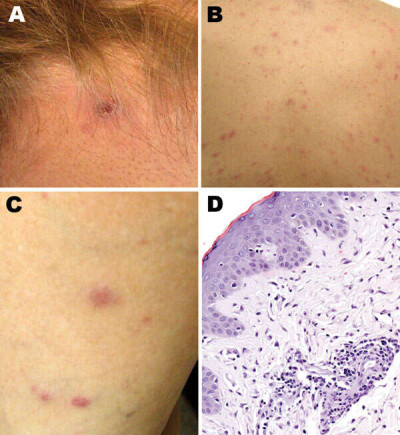 Rickettsia parkeri Rickettsiosis Argentina Eschar Papulovesicular Rash Histopathology