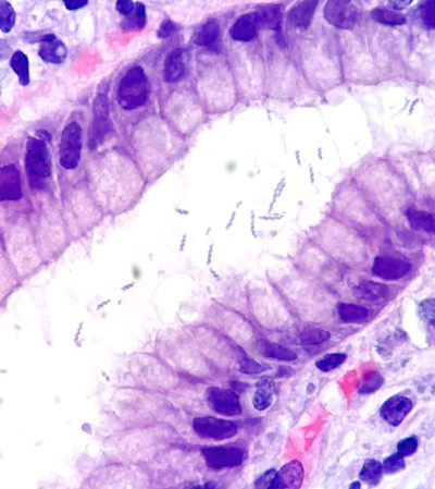 Helicobacter heilmannii in Gastric Mucosa