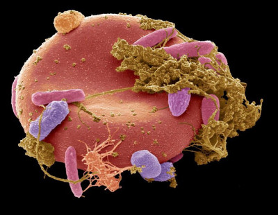 Red Blood Cell with Fecal Bacteria