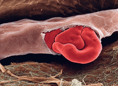 Red Blood Cells Exiting Ruptured Capillary