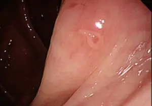 A Case of Echinostoma cinetorchis Infection Diagnosed by Colonoscopy