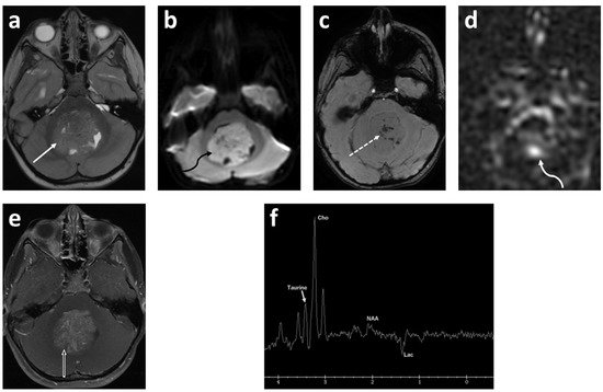 Pediatric Brain Tumors Encyclopedia Mdpi 8533