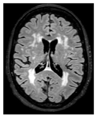 Microvascular Disease in Heart and Brain by MRI | Encyclopedia MDPI