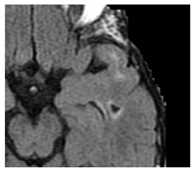 Microvascular Disease in Heart and Brain by MRI | Encyclopedia MDPI