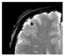 Microvascular Disease in Heart and Brain by MRI | Encyclopedia MDPI