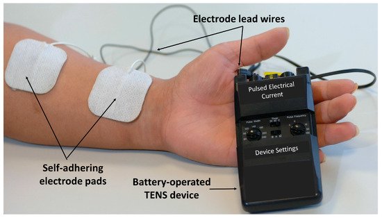 Transcutaneous Electrical Nerve Stimulation (TENS) - A Canadian