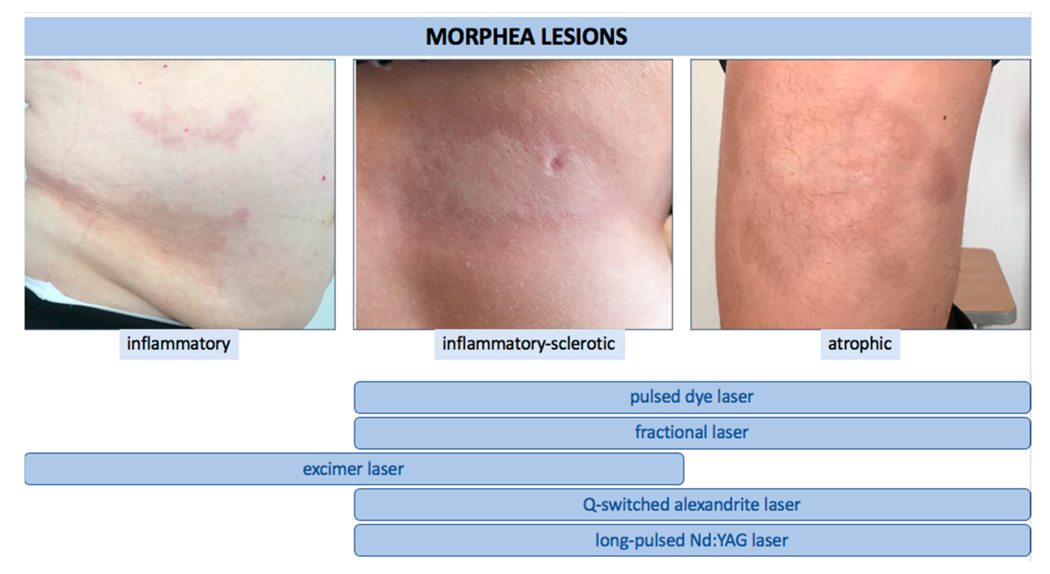 morphea scleroderma