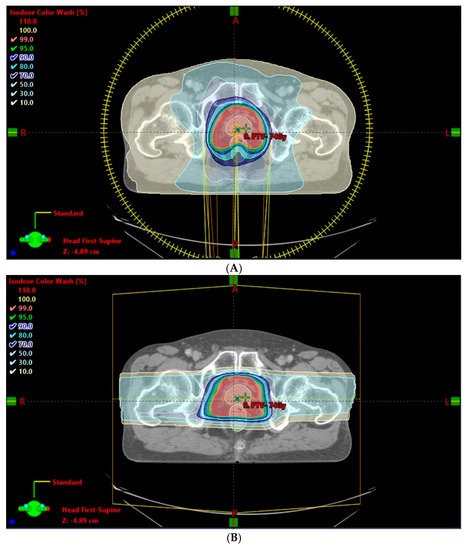 Proton Therapy For Prostate Cancer | Encyclopedia MDPI