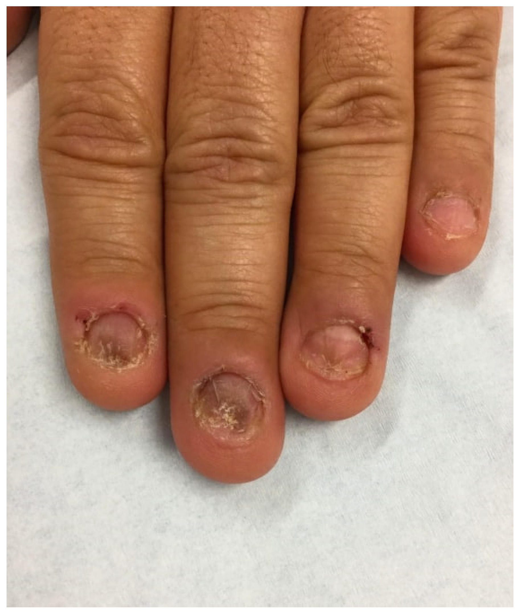 Translated article] Frontal Examination of the Distal Nail Unit