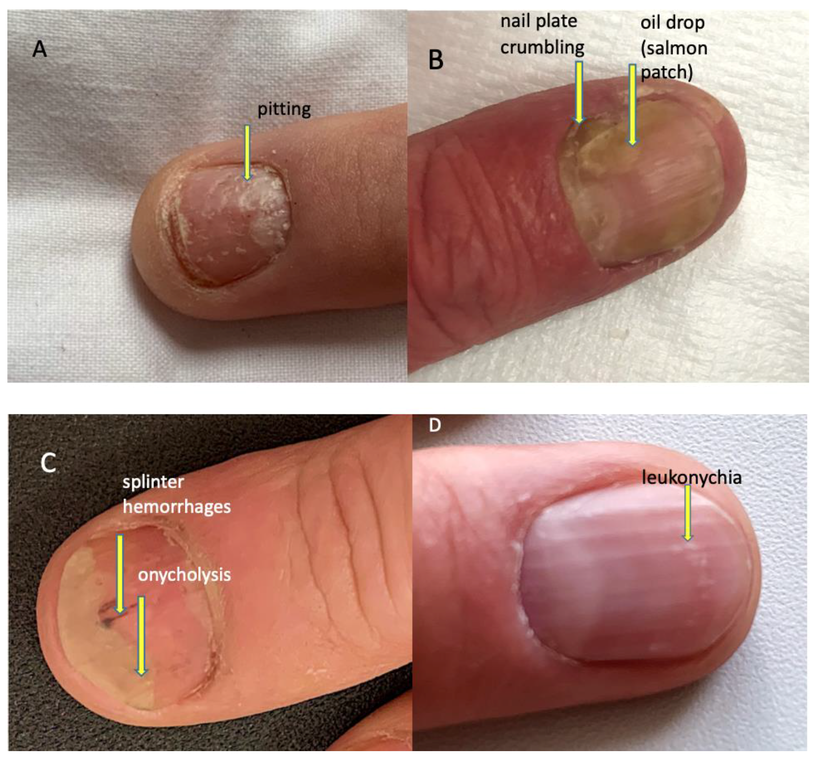 Pulsoca - White Spots On Nails: Should You Be Worried?... | Facebook