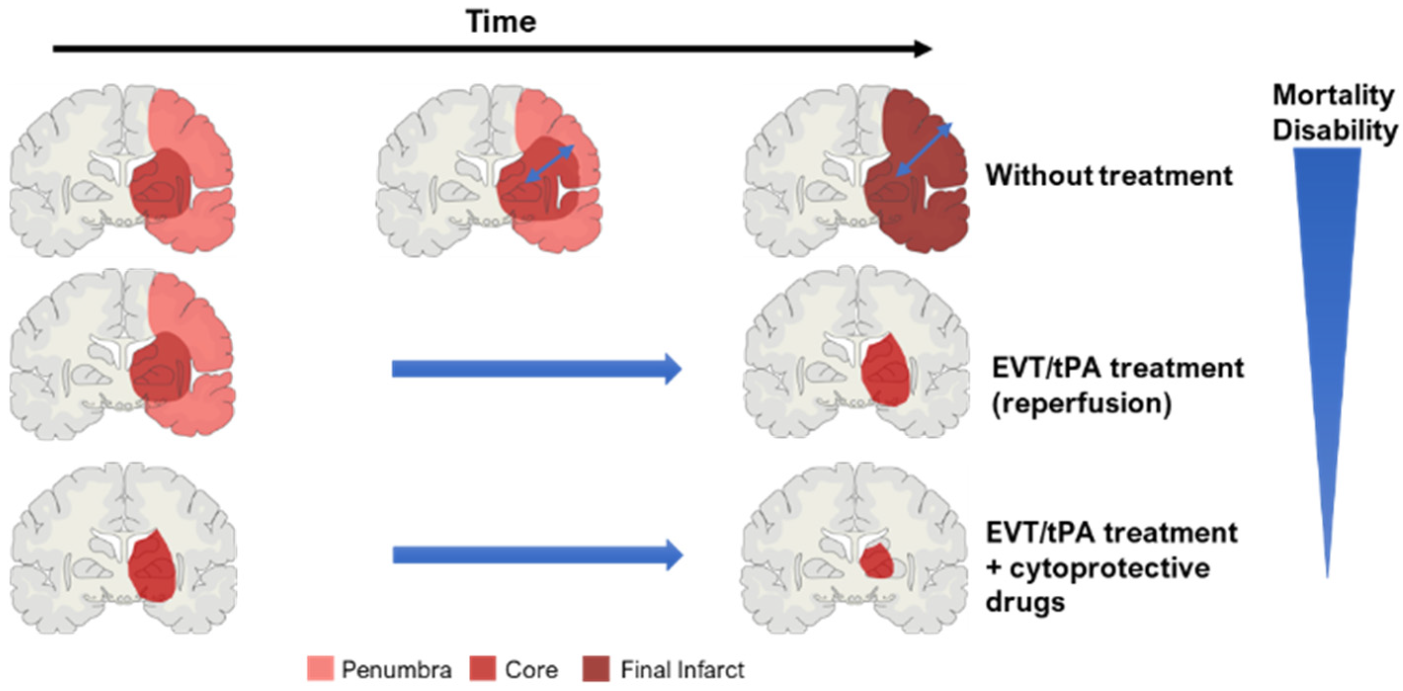 Ischemic Stroke Pathophysiology Thromboinflammatory Challenges In