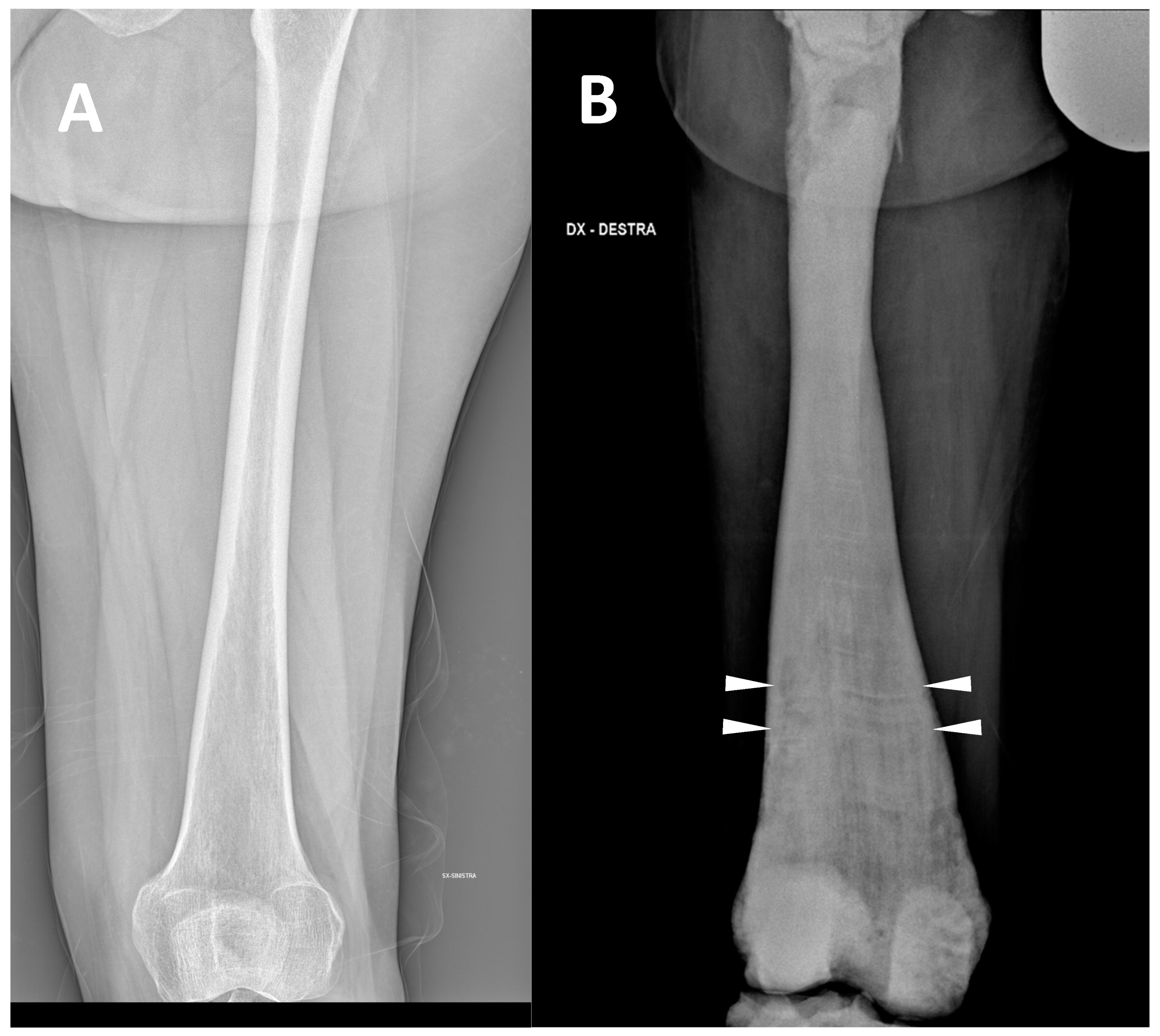 Skeletal Imaging Features in Osteopetrosis | Encyclopedia MDPI