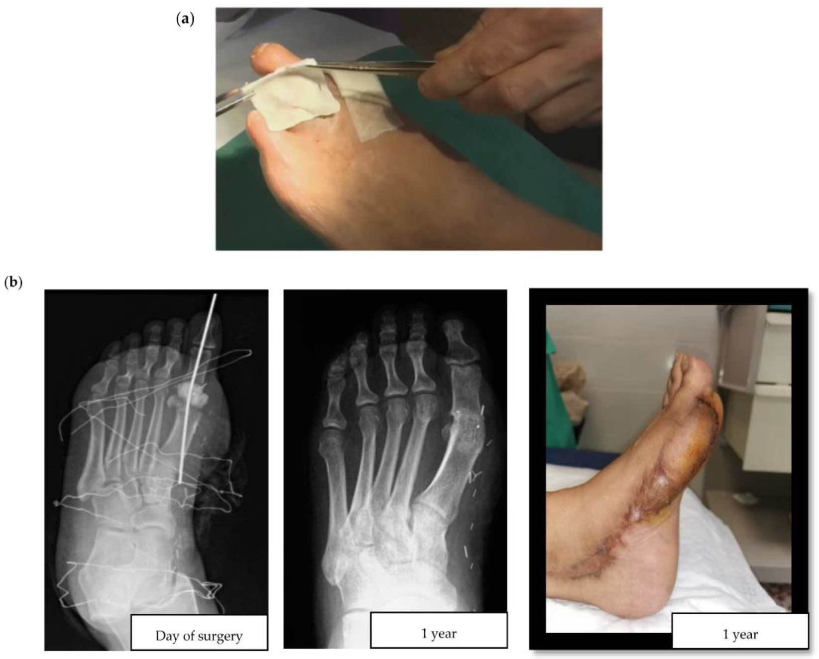 local-antibiotics-in-treatment-of-diabetic-foot-infections