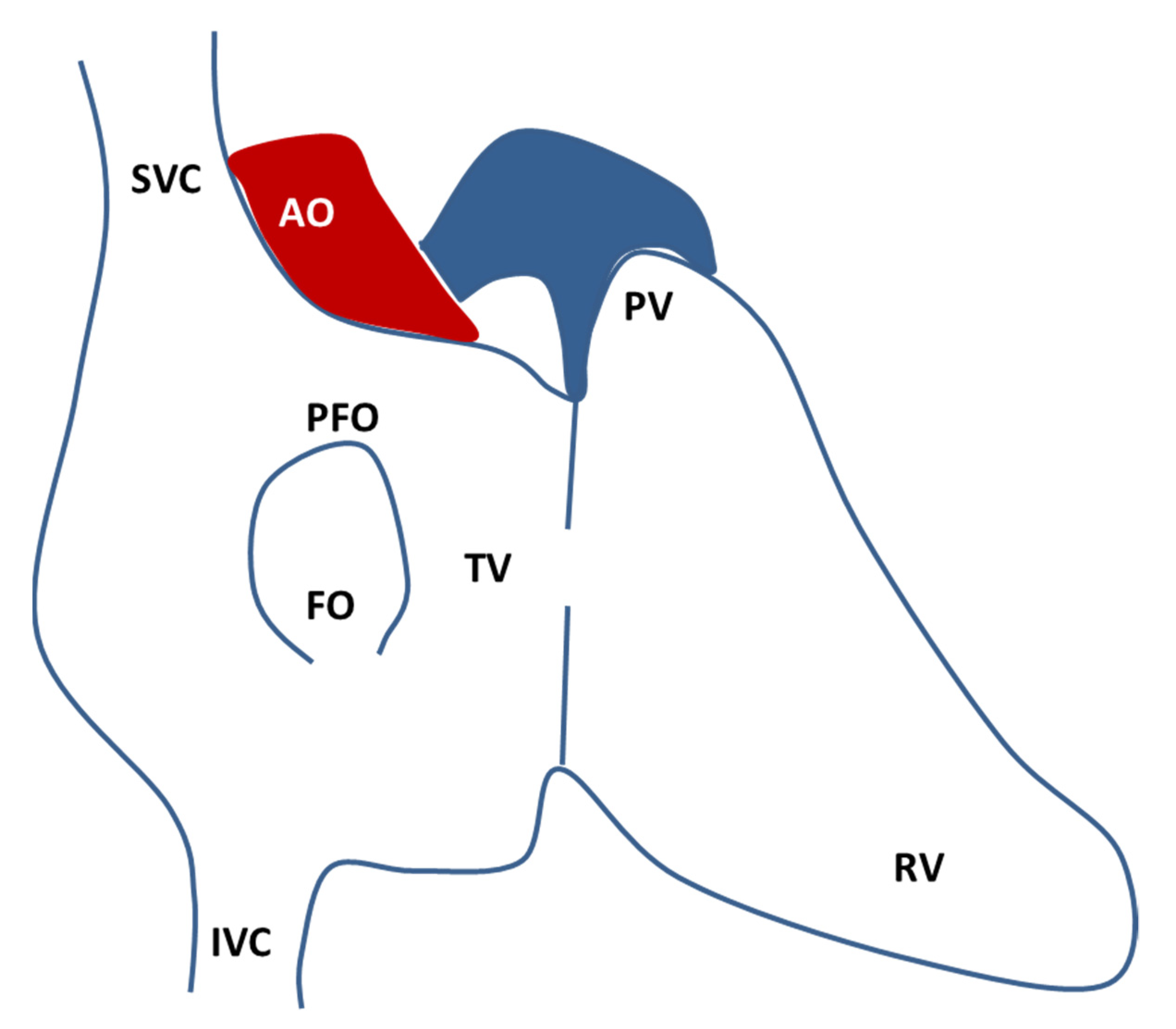 The Genetic Landscape Of Patent Foramen Ovale Encyclopedia Mdpi