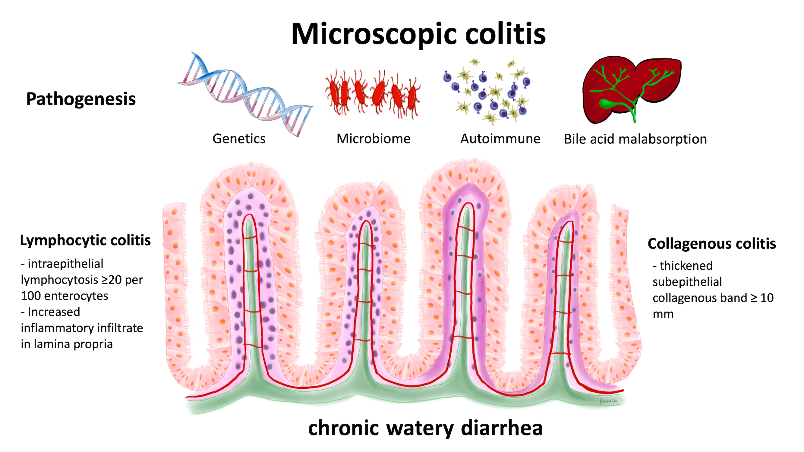 Graphical abstarct: Pathogenesis of microscopic colitis