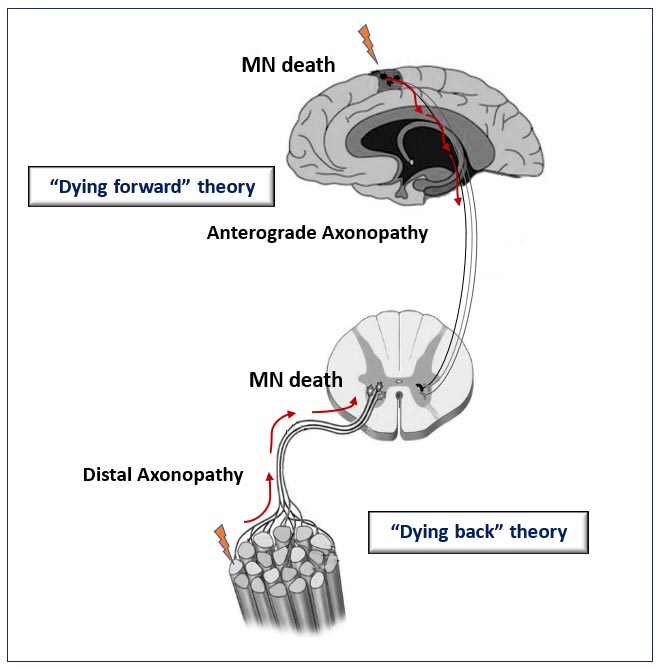 Anterograde and Distal Axonopathy