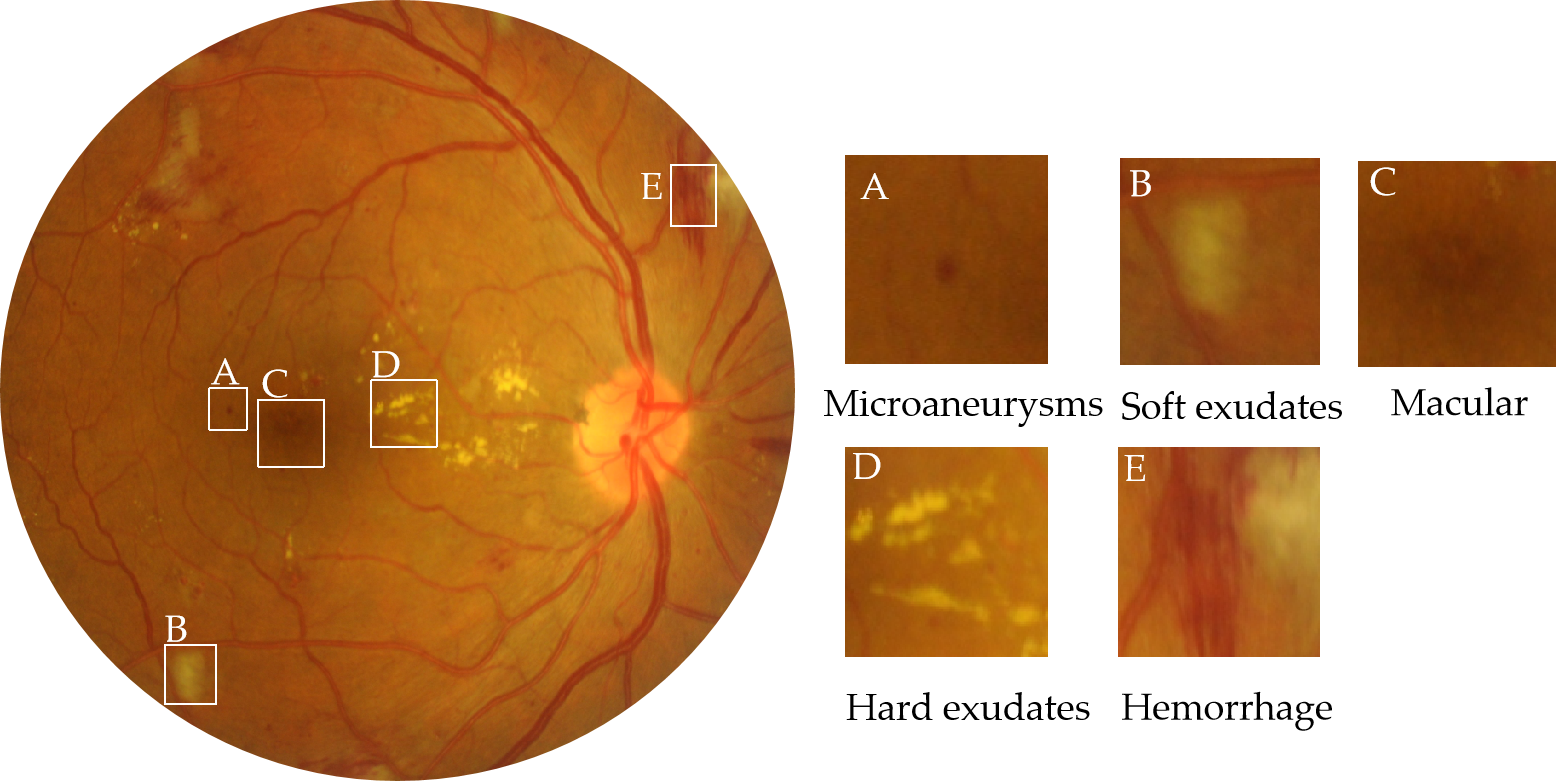 Figure 1. Fundus images from the IDRiD dataset with hard exudates, soft exudates, hemorrhage, microaneurysms, and other lesions. The severity of DR is related to microaneurysms, hemorrhage, soft exudates, and hard exudates. The severity of DME is determined by the distance from hard exudates to the macular area.