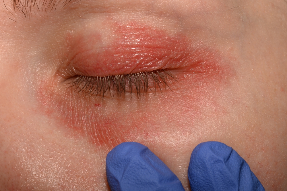 psoriasis on the eyelids