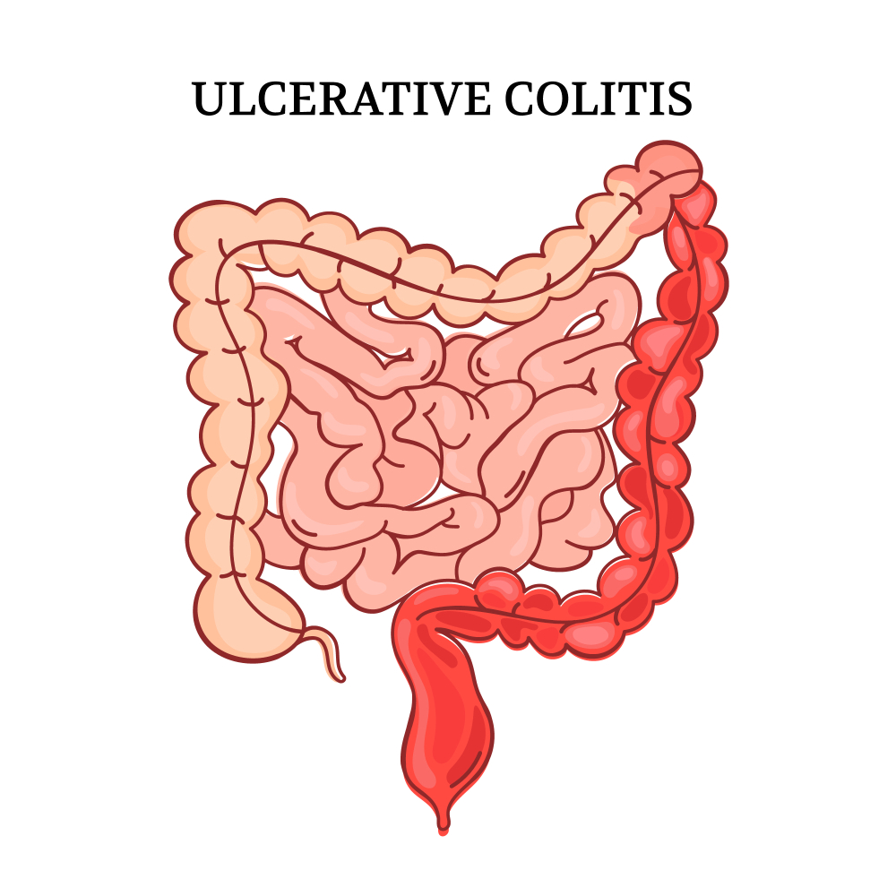 is ulcerative colitis a disability