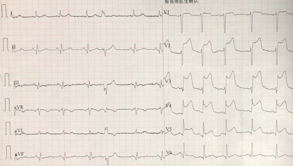 Figure1. Initial ECG (anterior STEMI) prompted cath lab activation.