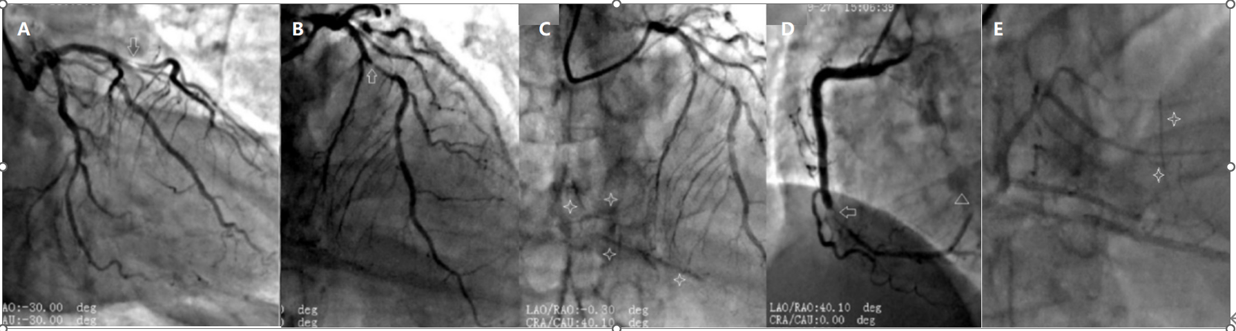 Figure2. CAG shows: severe proximal LAD stenosis (A,B, arrows); subtotal mid RCA occlusion (D, arrow); CC  from the LAD to the RCA is visible (C, four-pointed star), along with  competitive flow in the left posterior lateral branch (D, triangle),Post-stent angiography of the right coronary artery demonstrating CC from the RCA to the LAD (E,four-pointed star). 