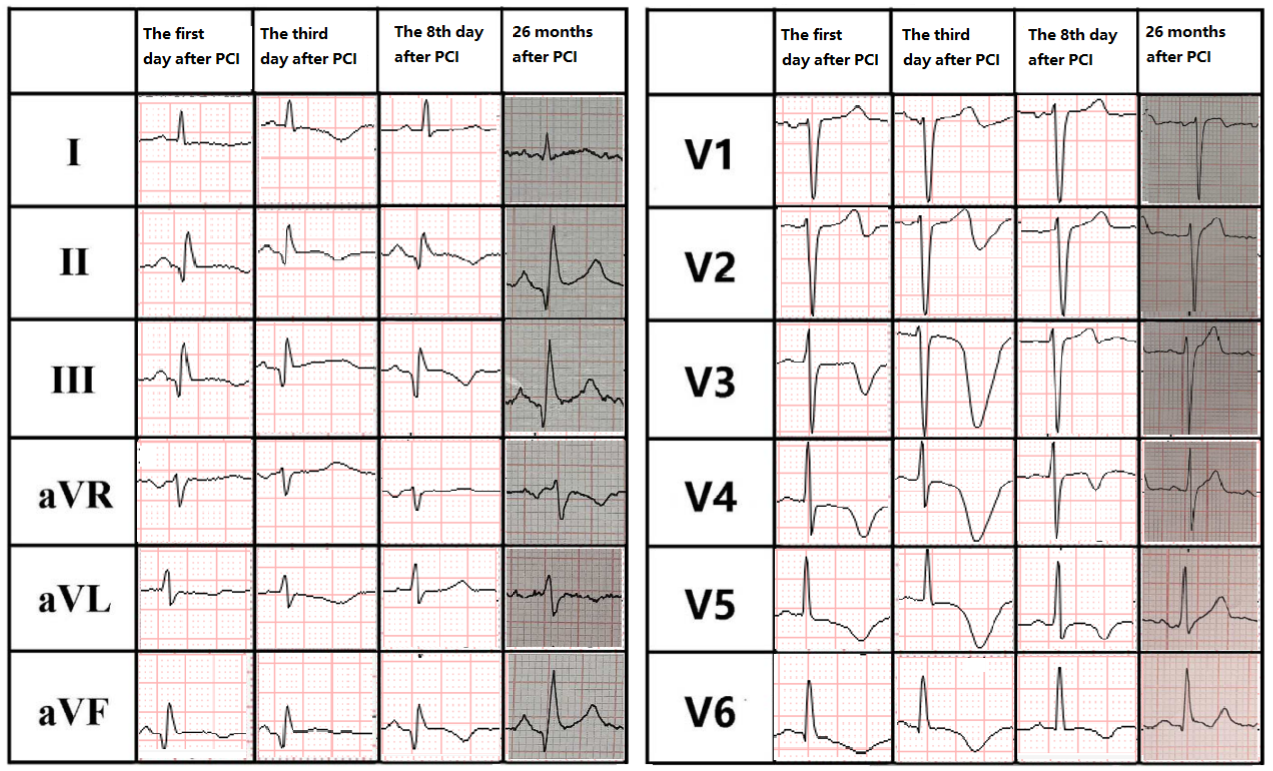 Figure 3. ECGs obtained on day 1, day 3, day 8, and at 26 months after PCI.